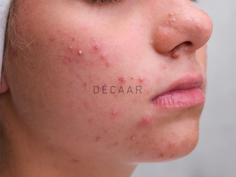 vì sao tuổi dậy thì hay bị mụn trứng cá